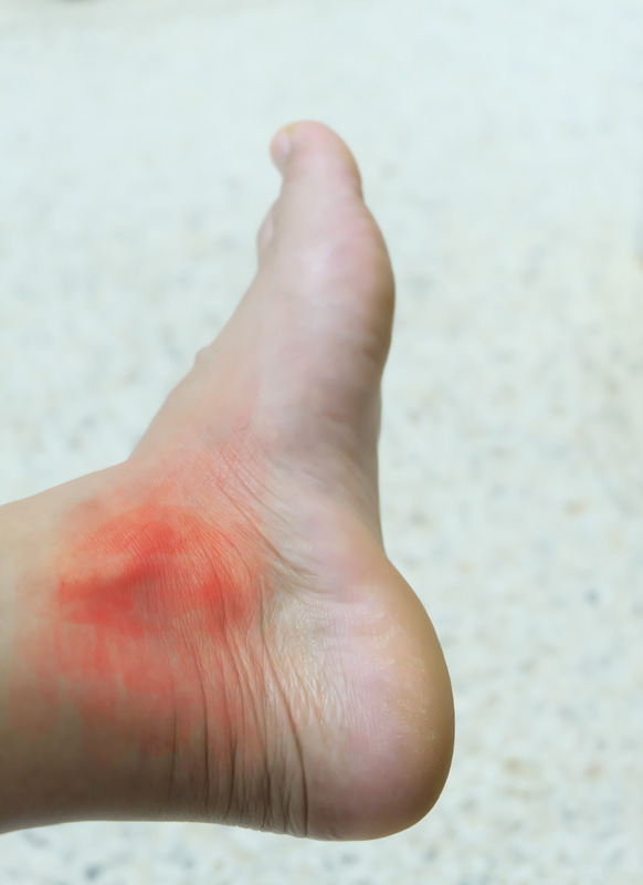 Foot of gout patient. Close up Painful and inflamed gout.