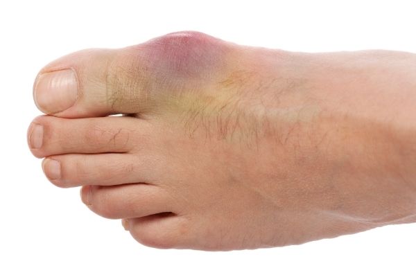 Can Gout be Cured? – Can Gout be Cured with Medications?