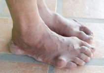 Is gout contagious