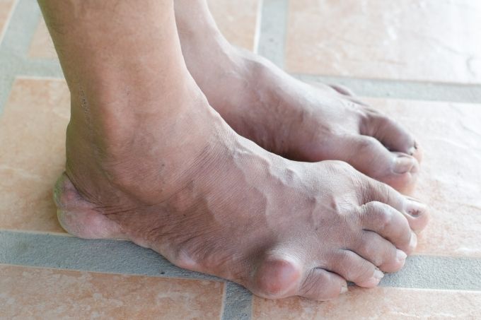 is gout contagious