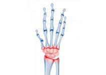 Pisotriquetral Arthritis