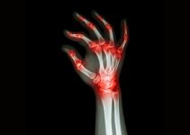 How to Prevent Arthritis in Hands – Symptoms and Prevention