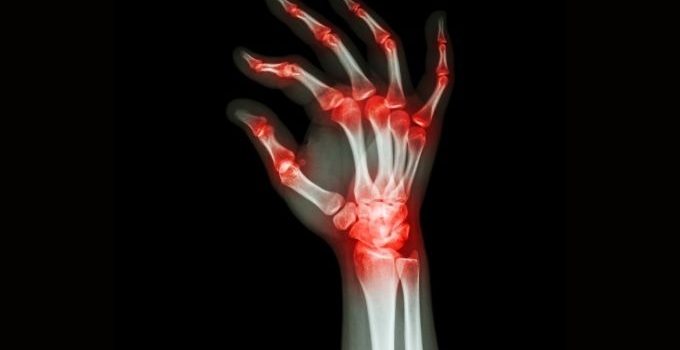 how to prevent arthritis in hands