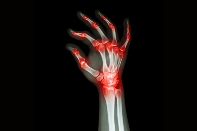 how to prevent arthritis in hands