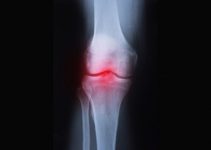 How To Prevent Arthritis In Knees – Info and Prevention