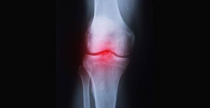 How To Prevent Arthritis In Knees – Info and Prevention