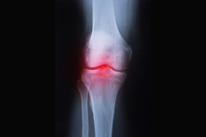how to prevent arthritis in knees