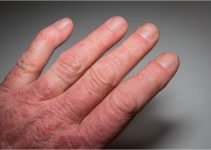 what are the first signs of psoriatic arthritis
