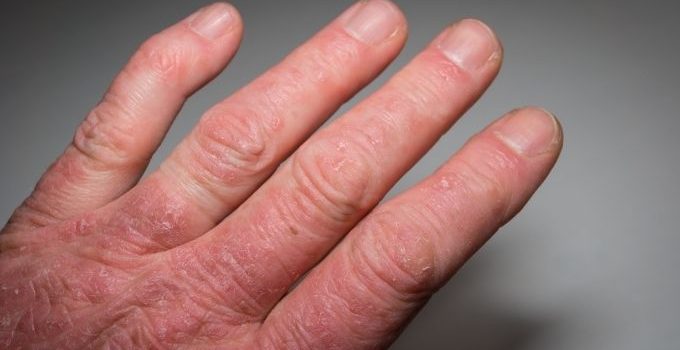 what are the first signs of psoriatic arthritis