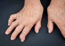 Arthritis in Hands – Causes, Symptoms, Treatment