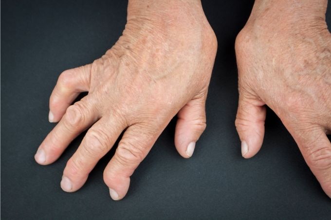 Arthritis in Hands