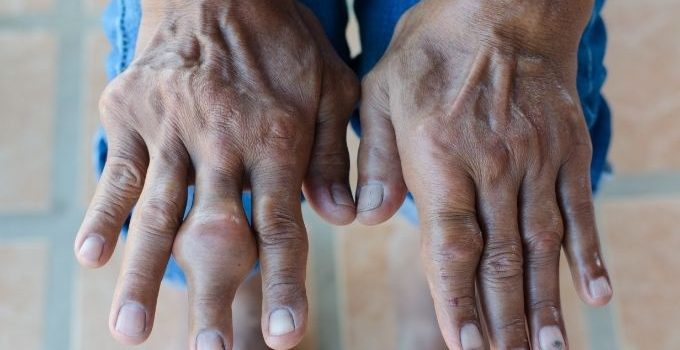 Gout in Finger – Risk Factors, Diagnoses and Treatment