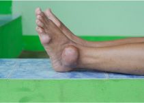 Gout in the Ankle – Symptoms, Causes, Treatment