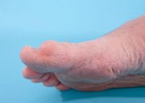 Gout vs. Bunion – The Difference Between Gout and Bunion
