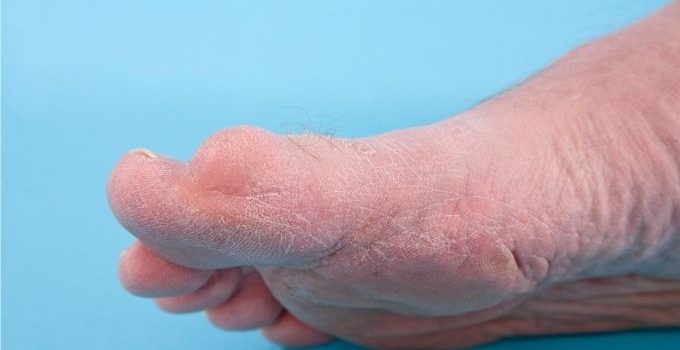 Gout vs. Bunion – The Difference Between Gout and Bunion