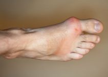 How Do You Get Gout? – 10 Causes & Risk Factors