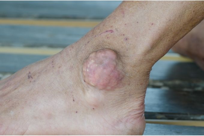ankle gout
