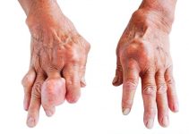Gout in Hands – Symptoms, Causes, Treatment