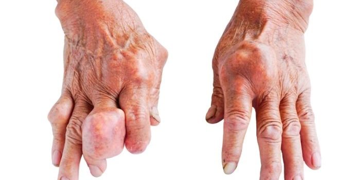 Gout in Hands – Symptoms, Causes, Treatment